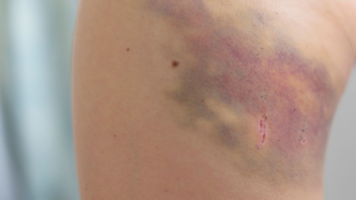 Do najczęstszych obrażeń tkanek miękkich należą stłuczenia