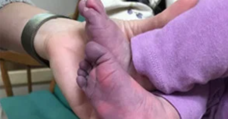 Blue COVID. Matka pokazała niemowlę z "covidowymi palcami"