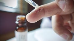 Kwas salicylowy - charakterystyka, źródła kwasu salicylowego, objawy alergii