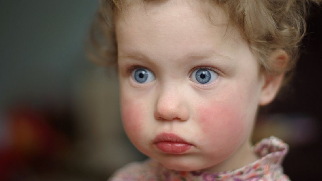 Czerwone policzki u dzieci i niemowląt