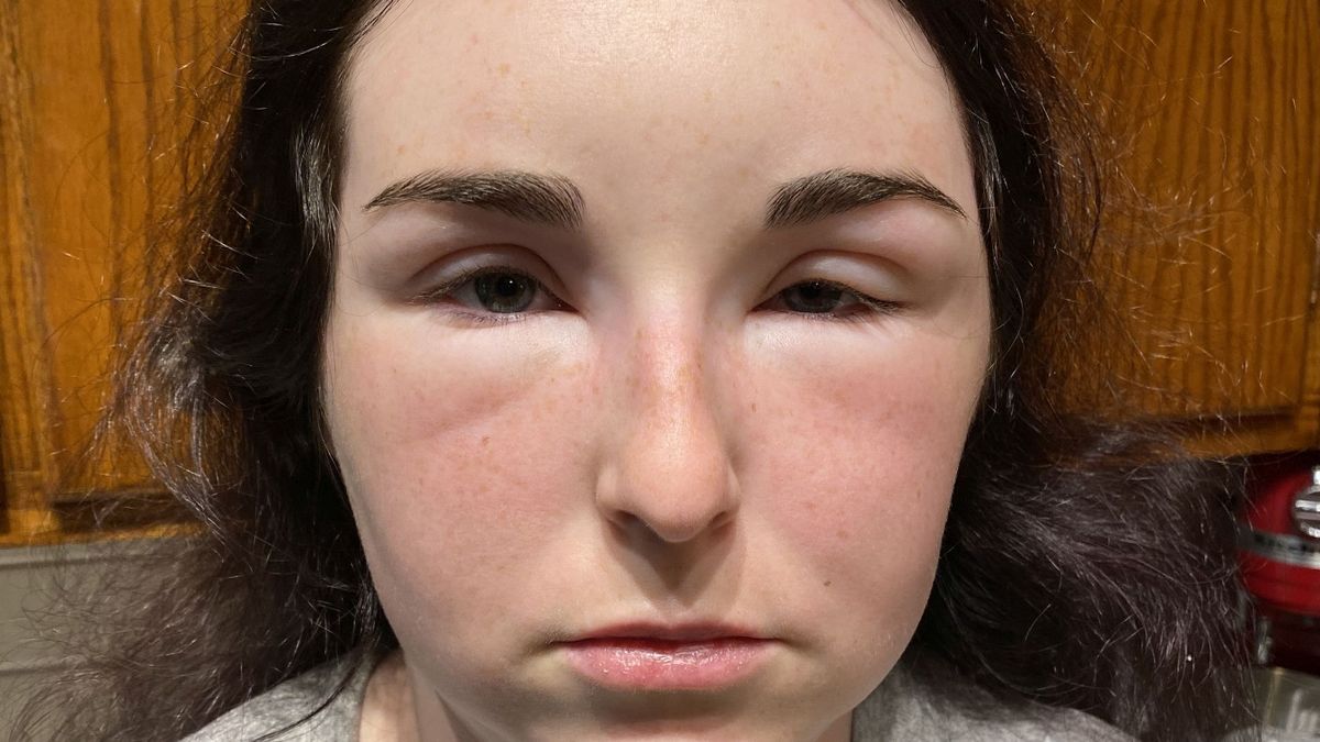 Shaylene miała obrzęk twarzy po farbie do włosów