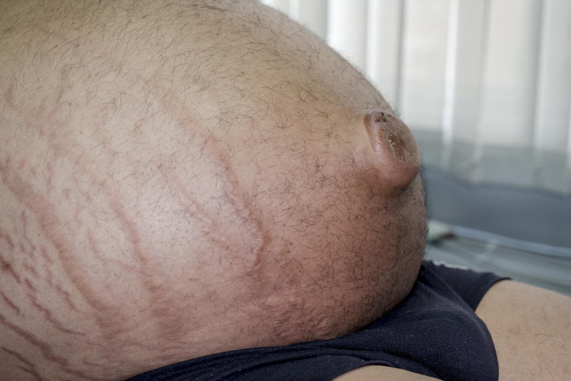 Wodobrzusze jest jednym z najbardziej alarmujących objawów