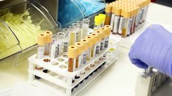 Azotyny w moczu - przyczyny, badanie moczu, infekcja dróg moczowych, ciąża