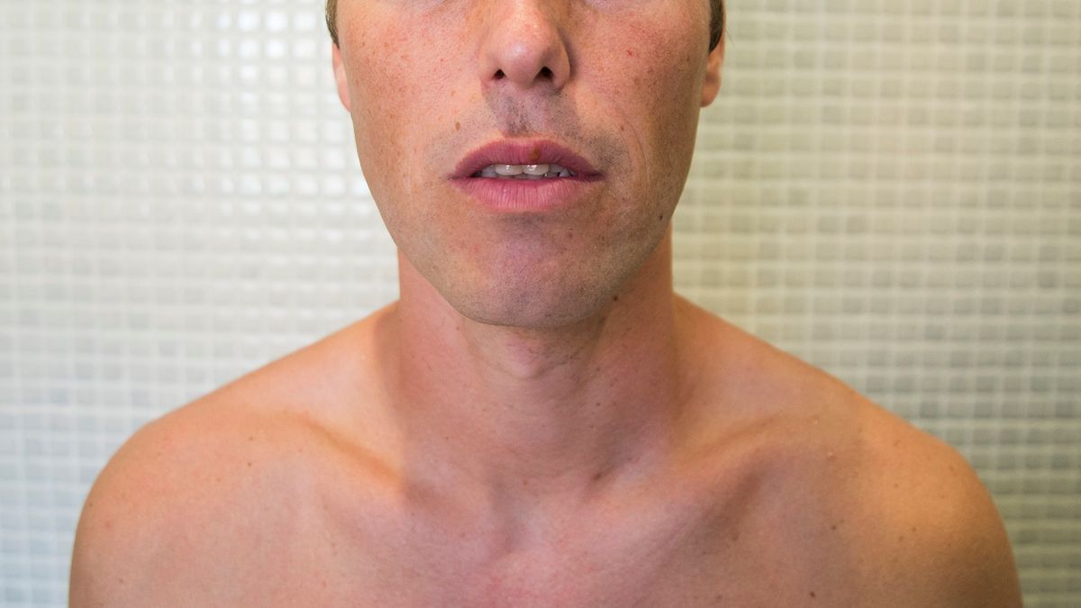 Rak jelita grubego może dawać przerzuty do jamy ustnej