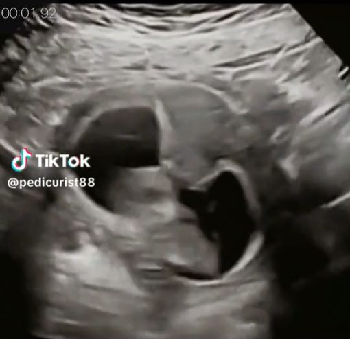 Widoczny na nagraniu płód rytmicznie podskakuje. Powodem jest czkawka