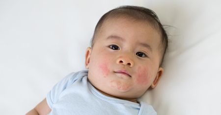 Rumień zakaźny u dzieci - przyczyny, objawy i diagnoza