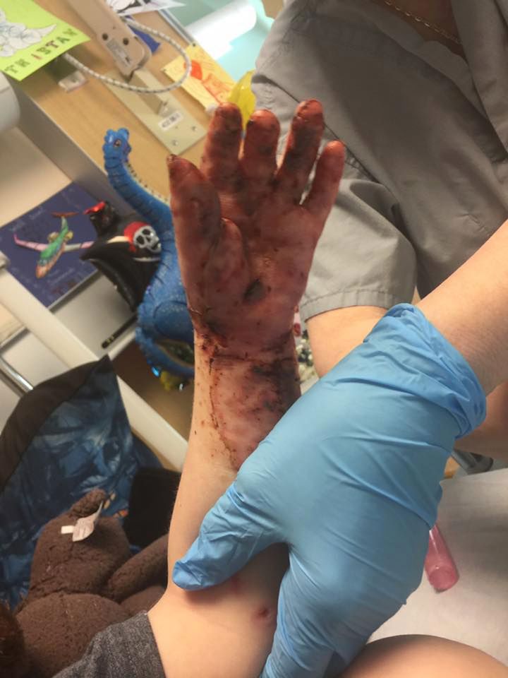 Wystarczyło 30 sekund, by ręka chłopca doznała tak wielkich uszkodzeń