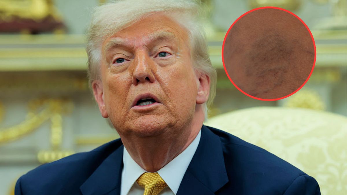 U Trumpa wykryto przewlekłą niewydolność żylną