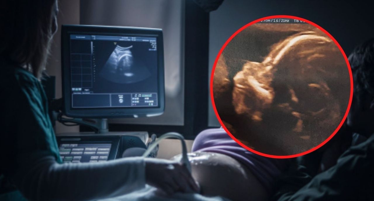 Usłyszała, że płód nie ma kości nosowej. Urodziła zdrową dziewczynkę