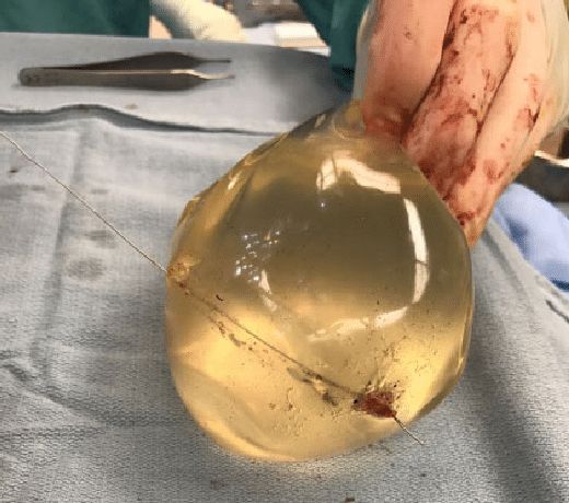 Implant zatrzymał kulę