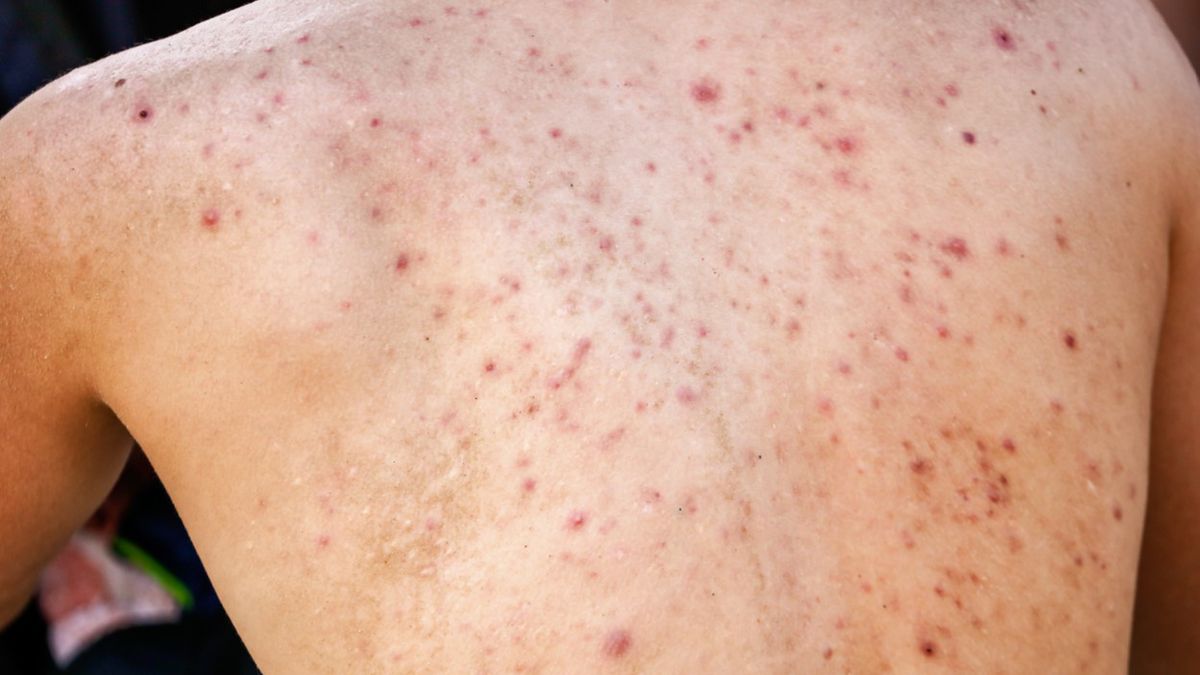 Bakteryjne zakażenia skóry to jedna z najczęstszych przypadłości, z którymi borykają się ludzie niezależnie od wieku czy płci