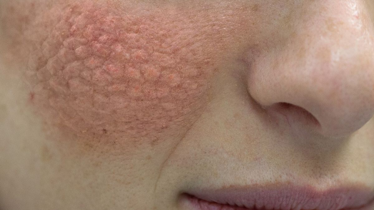 Nefropatia toczniowa jest choroba kłębuszków, podłoże której stanowi toczeń rumieniowaty układowy.