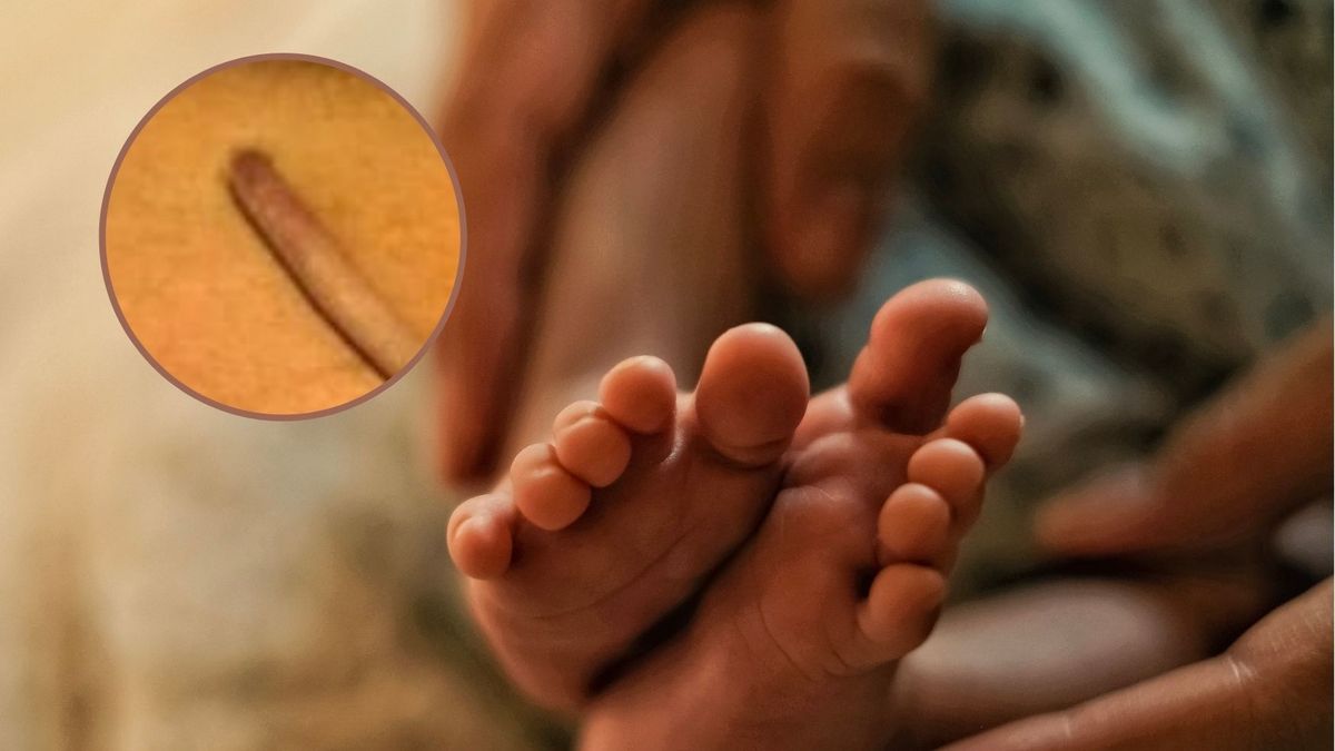 Urodził się z ogonem. Jest jednym z 40. udokumentowanych noworodków