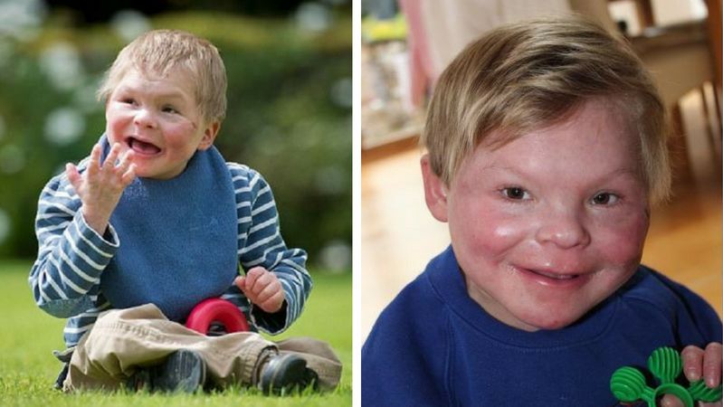 Angus jest pierwszym na świecie dzieckiem, u którego zdiagnozowano takie zaburzenie chromosomów