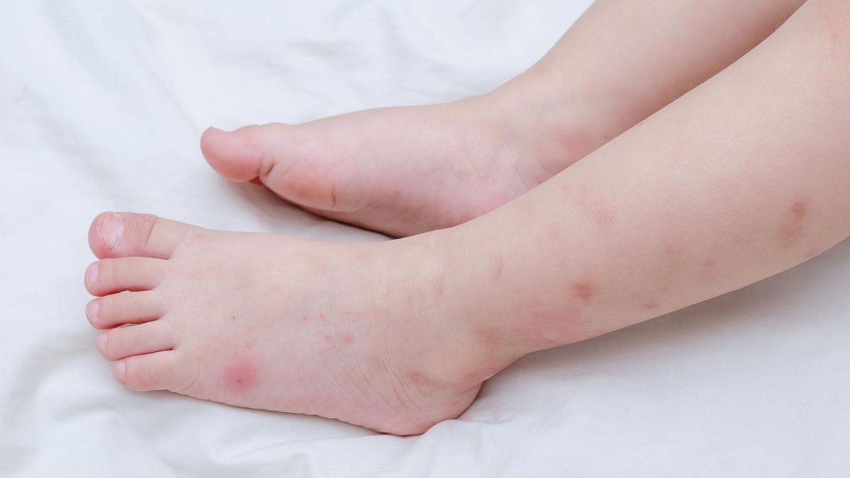 Alergia na jad meszek może prowadzić nawet do śmierci