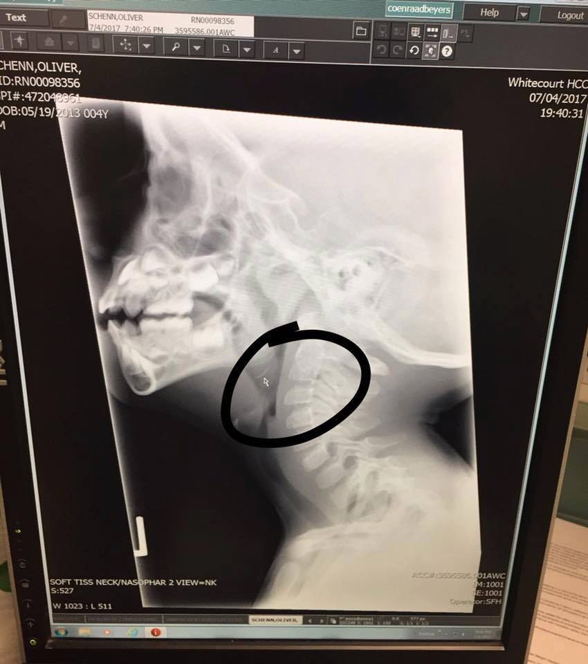 Mały Ollie połknął kawałek metalu