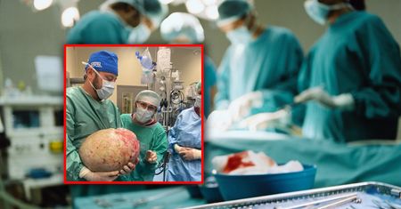 Usunęli guz jajnika ważący 20 kg. Takie dawał objawy