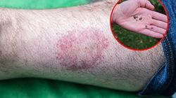  "Oko byka" pojawia się po ukąszeniu kleszcza. Jeśli je zauważysz, masz szczęście