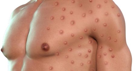 Pierwszy przypadek groźniejszego Mpox poza Afryką.