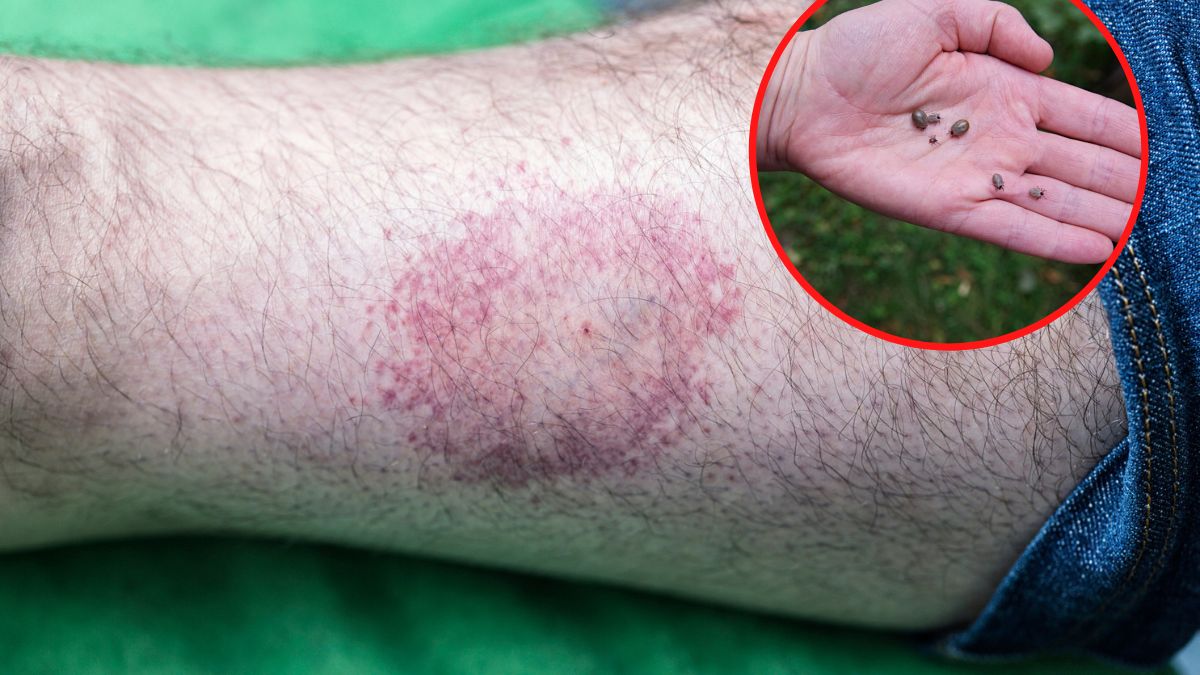 "Oko byka" pojawia się po ukąszeniu kleszcza. Jeśli je zauważysz, masz szczęście