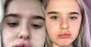 17-latka wstrzyknęła w usta wypełniacz. "Nienawidziłam swojej twarzy"