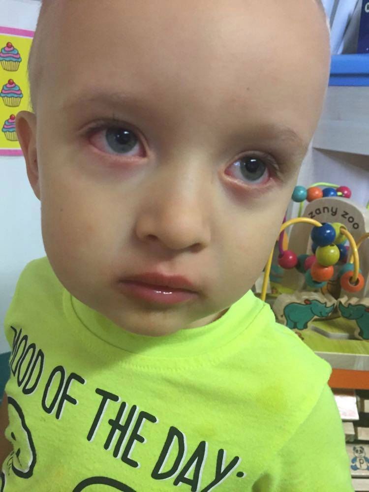 Już w szpitalu pojawił się kolejny objaw choroby - zaczerwienione oczy 