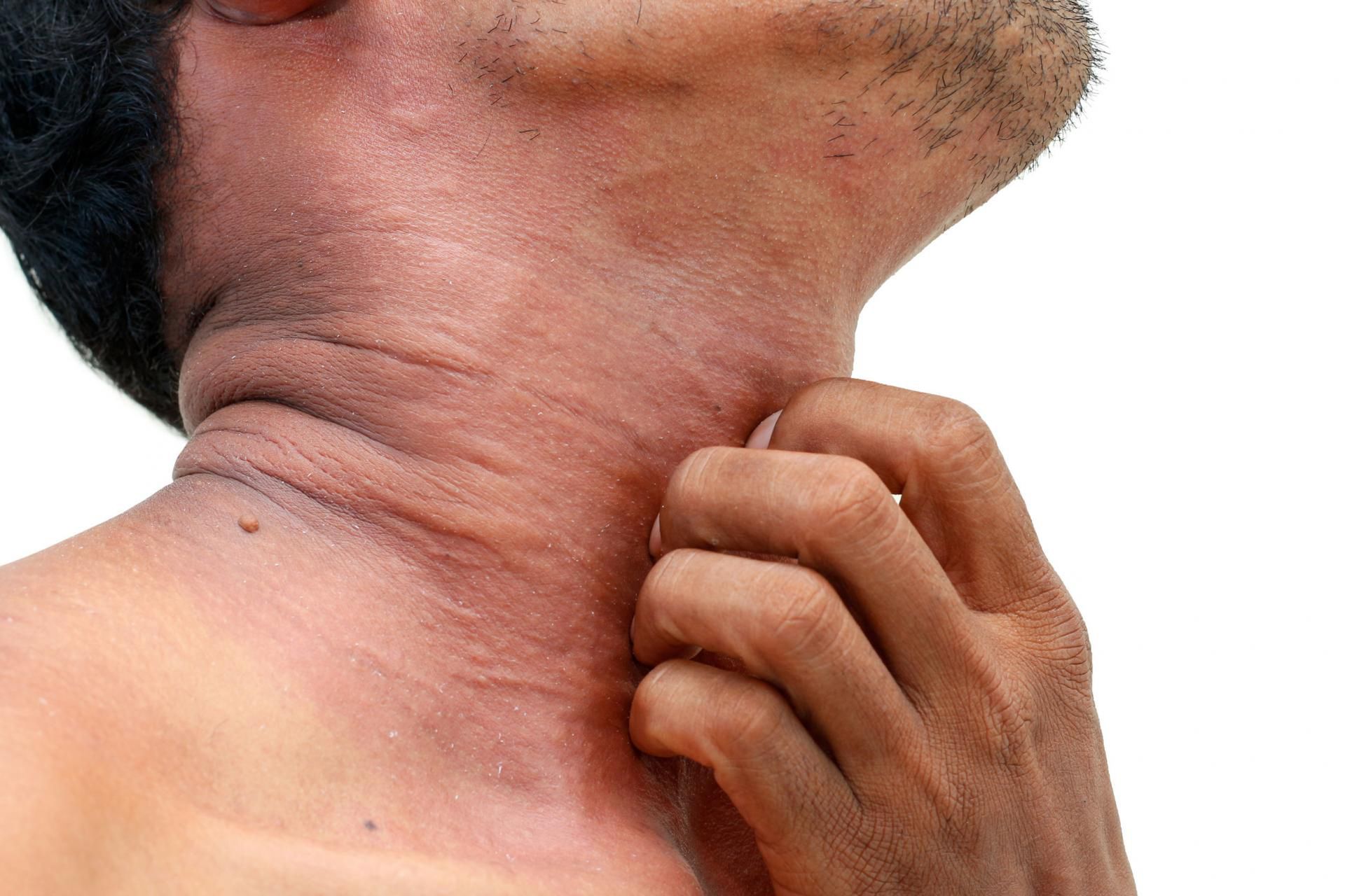 Atopowe zapalenie skóry nasila się zimą i wiosną