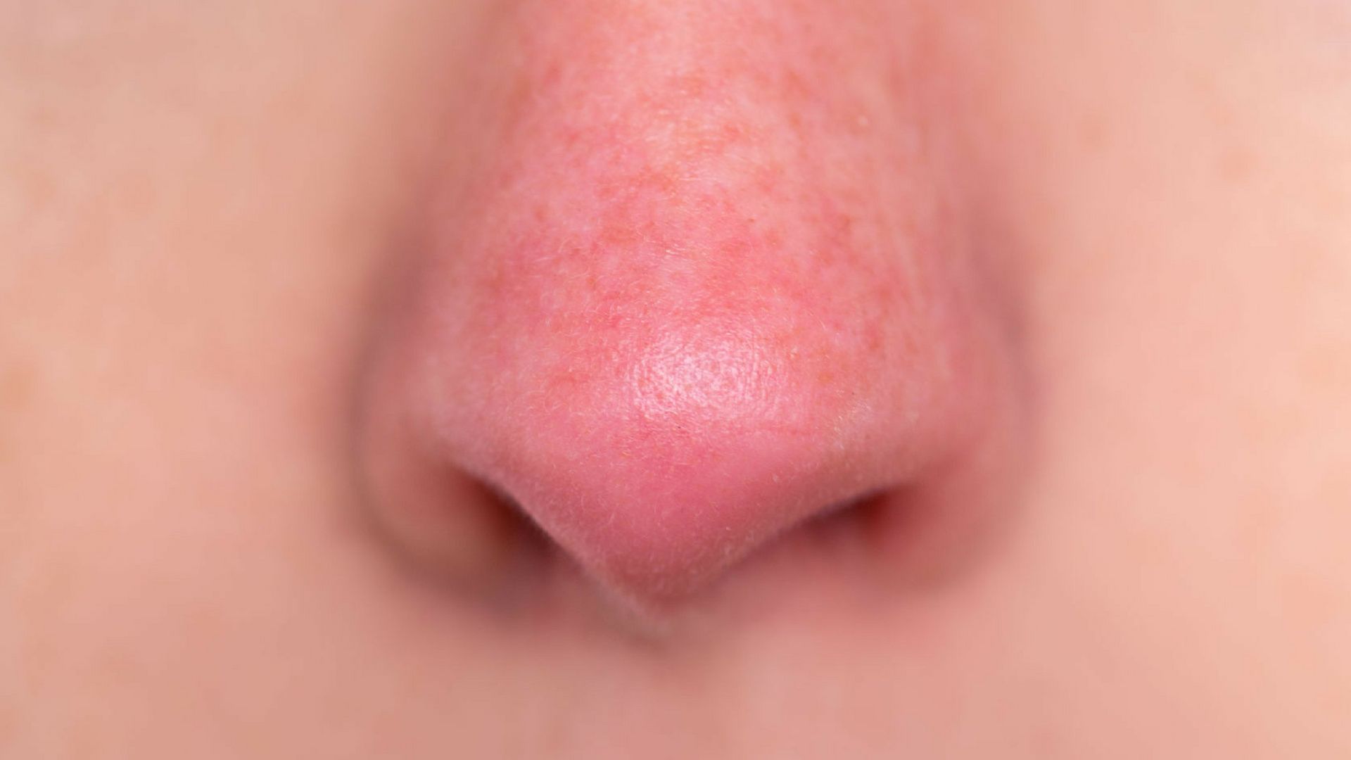 Czerwona skóra w okolicy nosa
