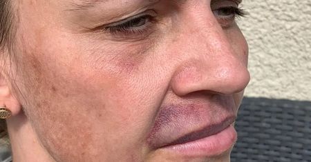 Kobietę skusił tani zabieg wypełniania ust. Jej twarz wyglądała, jak po wypadku samochodowym