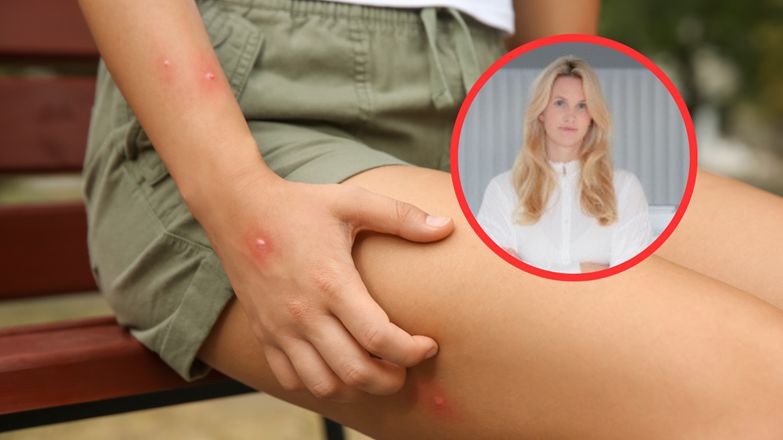 Jak zachować się po ukąszeniu przez owada?