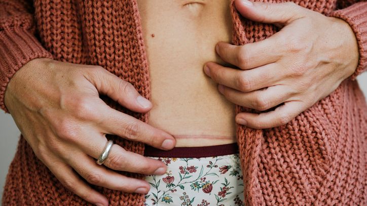 Plastry na blizny zmniejszają widoczność blizn po cięciu cesarskim i operacjach.