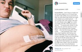 ”Jak po potrąceniu przez autobus” - młoda mama pokazuje prawdę o cesarskim cięciu