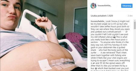 ”Jak po potrąceniu przez autobus” - młoda mama pokazuje prawdę o cesarskim cięciu