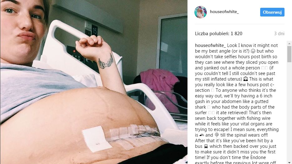 ”Jak po potrąceniu przez autobus” - młoda mama pokazuje prawdę o cesarskim cięciu