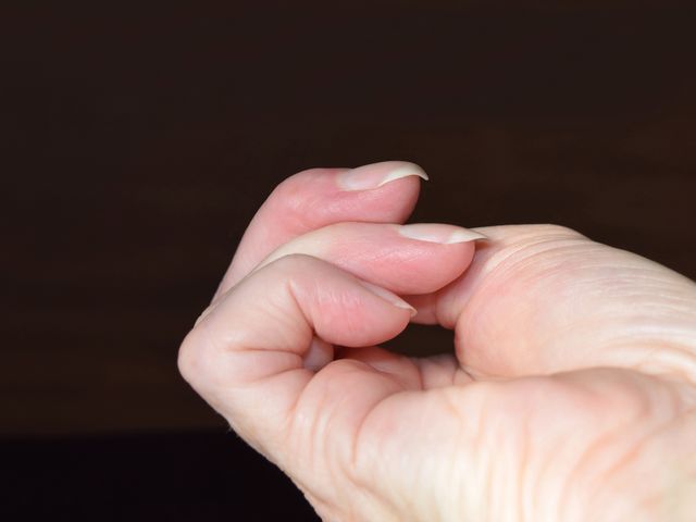 Charakterystycznie zakrzywione paznokcie mogą być objawem choroby
