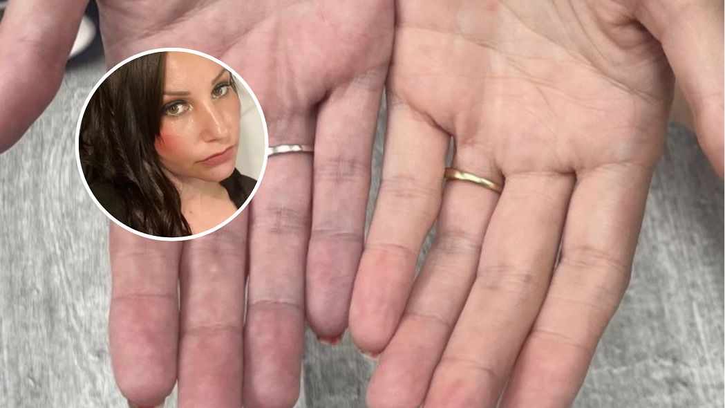 Marzyła o implantach piersi. Operacja plastyczna doprowadziła do rozerwania mięśni klatki piersiowej