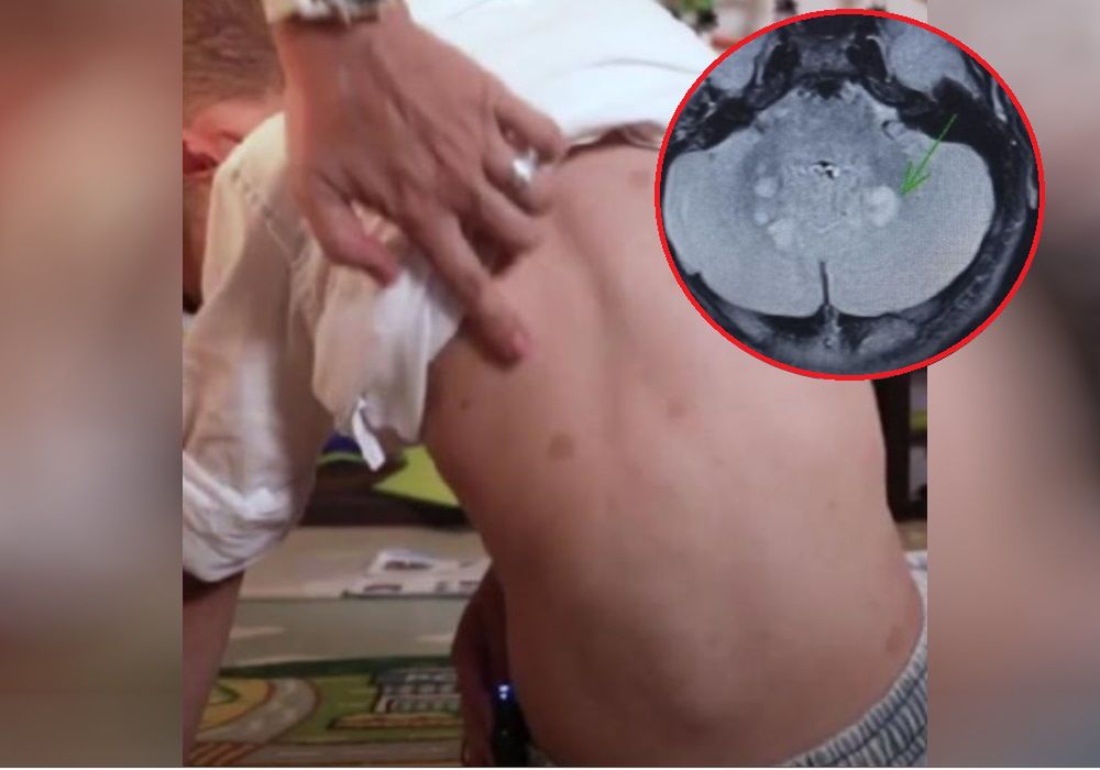 Myśleli, że to alergia na jajka. To odkryli w jego mózgu