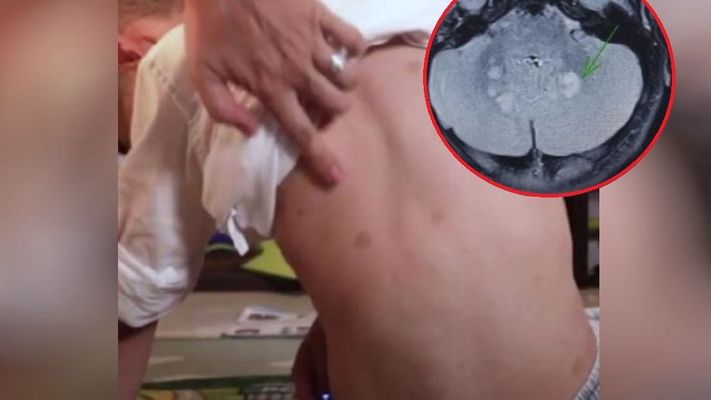 Znamiona na skórze dziecka zaniepokoiły lekarza. Odkrył, że ma rzadką chorobę