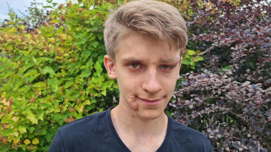 Choruje na neurofibromatozę typu I. Zbiera na kosztowne leczenie