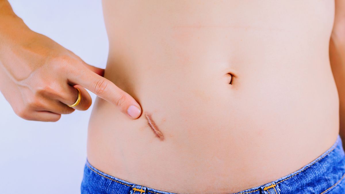 Wyrostek robaczkowy powoduje silny ból brzucha, wymioty oraz gorączkę.