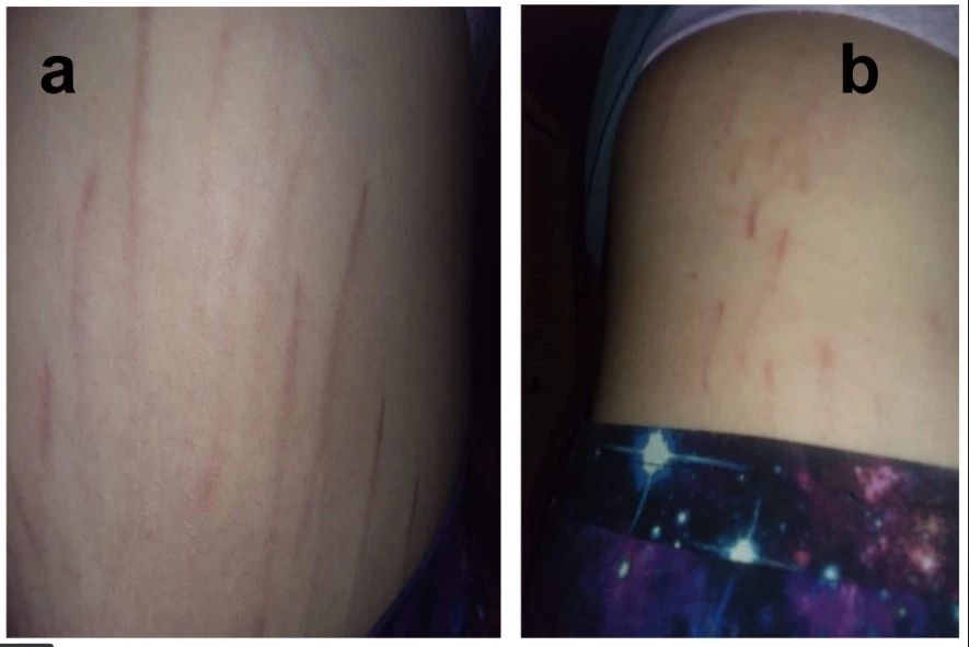 Choroba kociego pazura