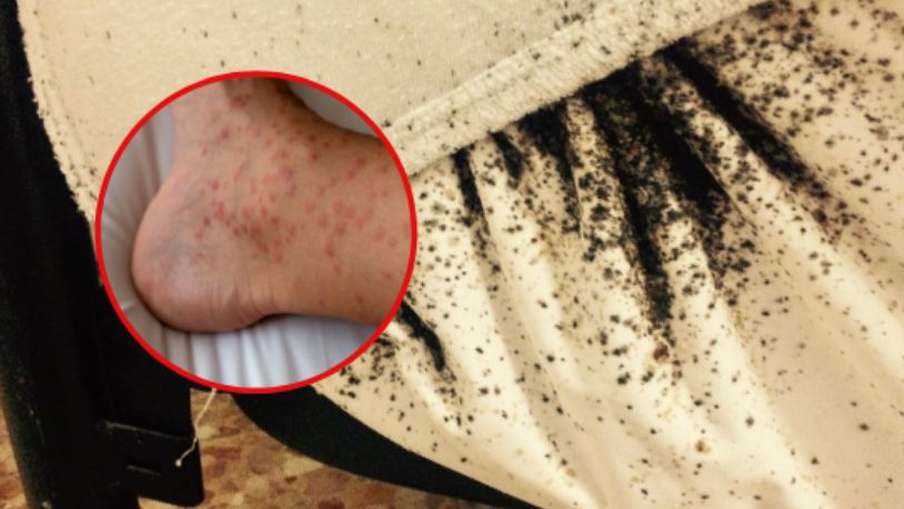 Olsztyn. 8-latka cały czas się drapała. Powodem były insekty