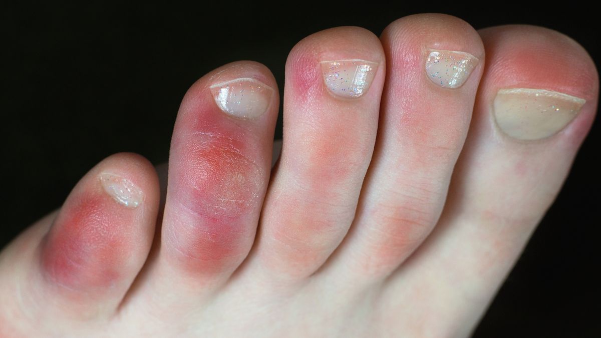 Palce covidowe to objaw występujący u niektórych osób chorych na COVID-19.