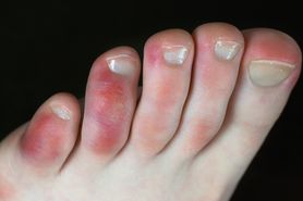 Palce covidowe - przyczyny, objawy, diagnostyka, leczenie