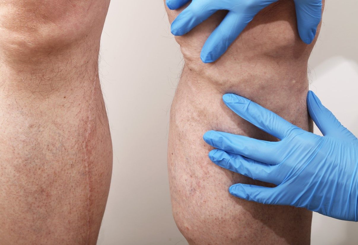 Żylaki - przyczyny, objawy, leczenie, domowe sposoby