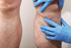 Żylaki - przyczyny, objawy, leczenie, domowe sposoby