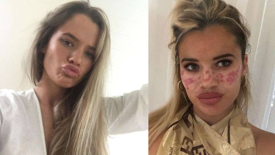 Celebrytka wylądowała w szpitalu. Wypróbowała trik z TiKToka i omal nie straciła wzroku