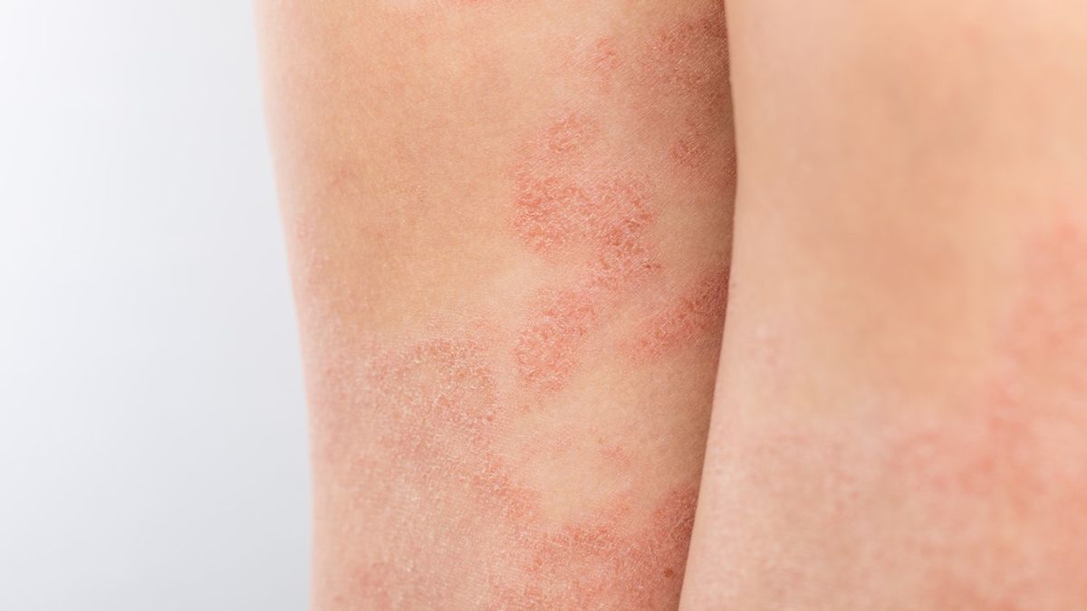 Czerwone plamy na nogach nie tylko nieestetycznie wyglądają, ale i bywają dokuczliwe.