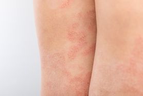 Czerwone plamy na nogach – najczęstsze przyczyny
