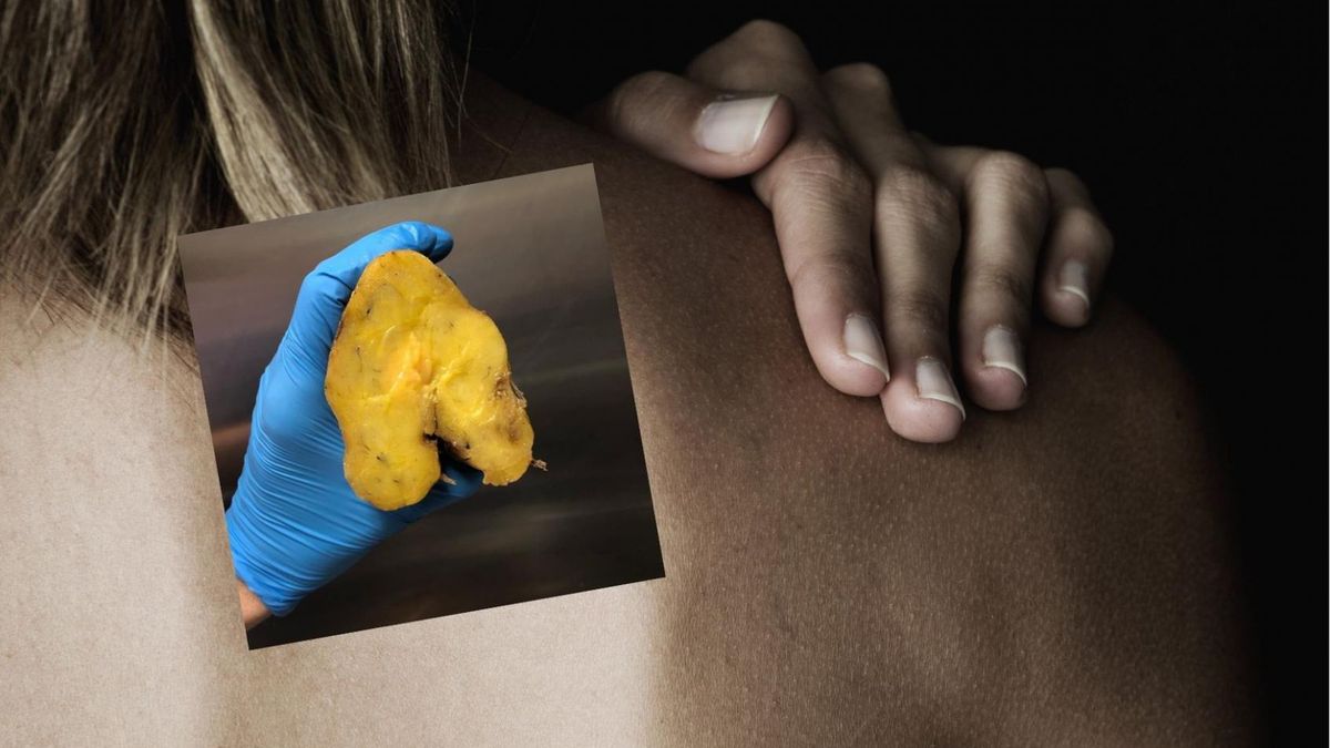 Lekarz ostrzega. Tłuszczak to najczęstszy nowotwór tkanek miękkich